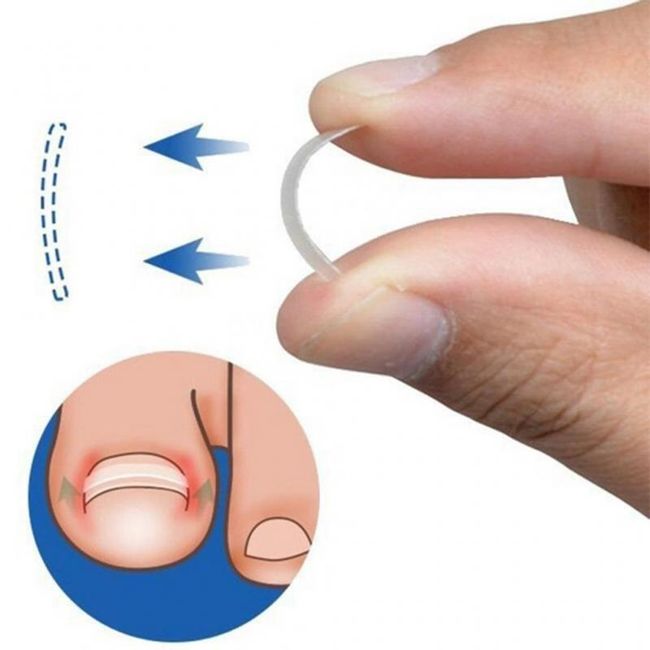 Set of anti - ingrown nail patches WS10 1