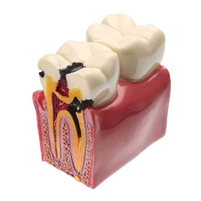 Zobozdravstveni model zoba - stol 1