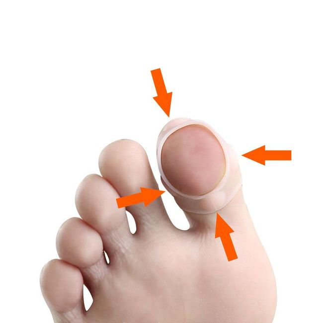 Ingrown toenail corrector SIL5 1