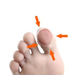 Ingrown toenail corrector SIL5