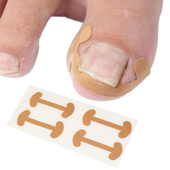 Zestaw plastrów przeciw wrastaniu paznokci U15 1